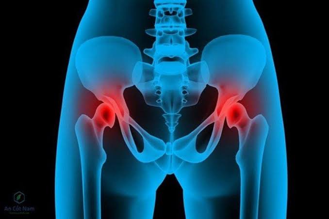 Hip osteoarthritis symptoms and monitoring — illustration of the hip joint showing cartilage loss in the acetabulum and femoral head, characteristic groin pain radiation, and reduced internal rotation range of motion