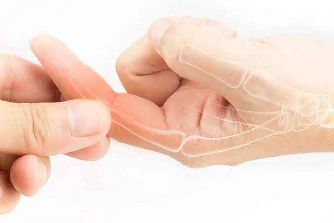 Hand osteoarthritis — diagram showing Heberden's nodes at DIP joints, Bouchard's nodes at PIP joints, and thumb base CMC joint OA with characteristic bony swelling