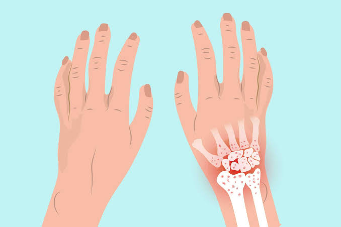 Hand osteoarthritis guide — illustration of the hand showing Heberden's nodes at the DIP joints, Bouchard's nodes at the PIP joints, first carpometacarpal joint OA at the base of the thumb, and the typical OA hand distribution