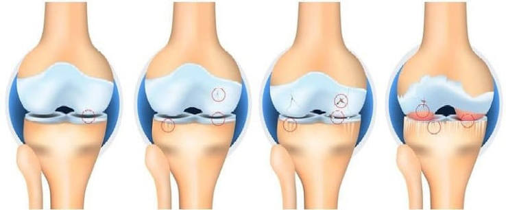 Osteoarthritis vs rheumatoid arthritis — comparison showing the different joint patterns, OA affecting weight-bearing joints and DIP joints, RA affecting MCP and PIP joints symmetrically