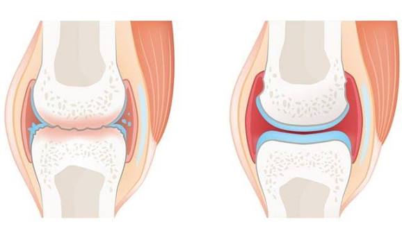 Osteoarthritis vs rheumatoid arthritis — side-by-side comparison of OA affecting weight-bearing joints and DIP joints versus RA affecting MCP and PIP joints symmetrically