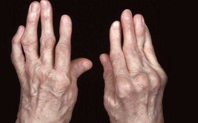 Rheumatoid arthritis symptoms and diagnosis — illustration showing symmetrical MCP and PIP joint swelling, prolonged morning stiffness, and positive anti-CCP blood test