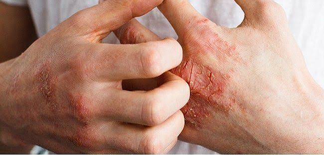 Psoriatic arthritis guide — illustration showing dactylitis (sausage digit), nail pitting, psoriatic skin plaques, and the asymmetric peripheral joint involvement characteristic of psoriatic arthritis