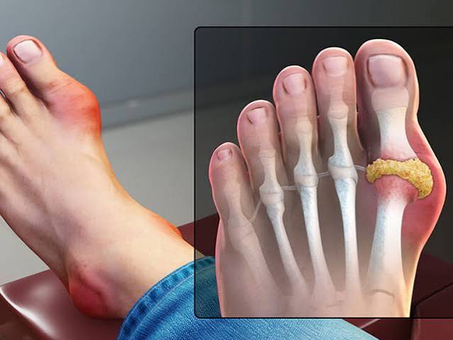 Gout symptoms causes and prevention — illustration showing a swollen red first metatarsophalangeal joint (big toe base) characteristic of acute gout attack, with tophi deposits and urate crystals