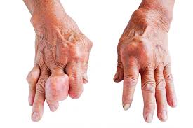 Gout symptoms causes and prevention — illustration showing a swollen red first metatarsophalangeal joint big toe base with tophi deposits and urate crystals characteristic of gout attack