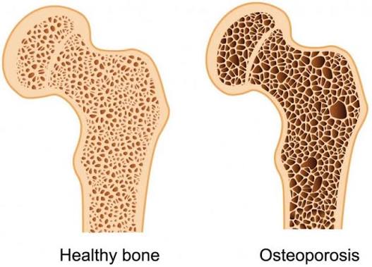 Osteoporosis bone microstructure comparison showing normal dense trabecular bone architecture on the left versus osteoporotic bone with thin porous trabeculae on the right illustrating the structural basis of fragility fracture risk