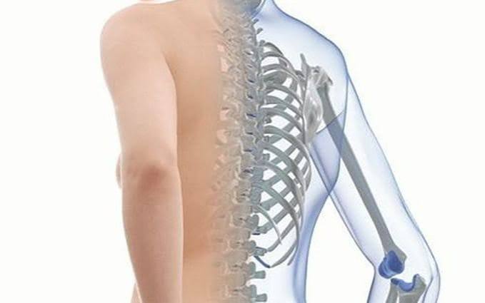 Osteoporosis illustrated showing an elderly woman with kyphosis and forward curvature of the spine caused by vertebral compression fractures alongside a DEXA scan result showing low bone density T-score