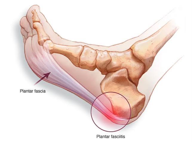 Plantar fasciitis illustration showing the plantar fascia origin at the medial calcaneal tuberosity on the heel bone with degeneration and microtears highlighted at the attachment site causing the first-step heel pain pattern