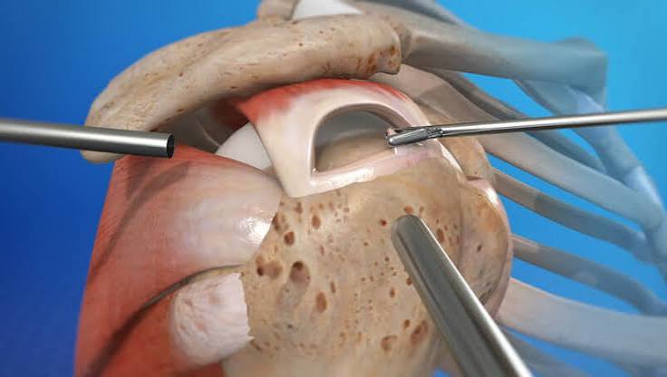 Rotator cuff problems diagram showing the supraspinatus tendon running through the subacromial space between the humeral head and the acromion with a full thickness tear highlighted and subacromial bursitis shown alongside