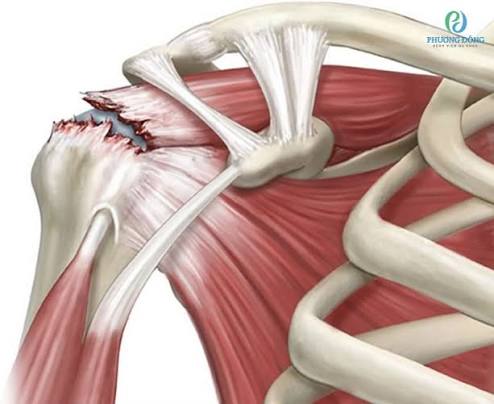 Rotator cuff anatomy diagram showing the four SITS muscles supraspinatus infraspinatus teres minor and subscapularis surrounding the glenohumeral shoulder joint with the supraspinatus running through the subacromial space beneath the acromion