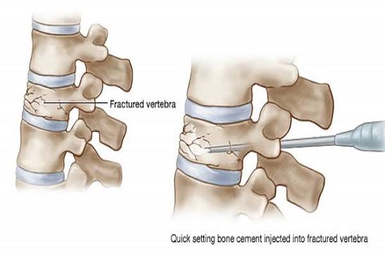 Spine compression fractures diagram showing wedge fracture anterior collapse producing thoracic kyphosis biconcave fish vertebra fracture and crush fracture with key risk factors including osteoporosis age over 65 prior vertebral fracture glucocorticoid use and the fracture cascade showing five times increased risk of second vertebral fracture in the year after a first