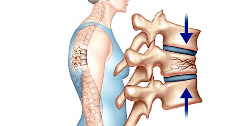 Spine compression fractures guide showing wedge fracture anterior collapse producing thoracic kyphosis and height loss biconcave fish vertebra fracture and complete crush fracture with the fracture cascade showing five times increased risk of second vertebral fracture in the first year after a first VCF and key management including analgesia physiotherapy bisphosphonates and vertebroplasty or kyphoplasty for acute refractory cases