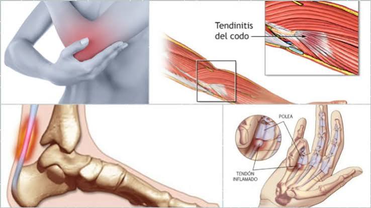 Tendinitis common sites diagram showing inflamed tendons at the Achilles heel, supraspinatus shoulder, lateral elbow, patellar knee, and wrist radial side with inflammation highlighted at each location