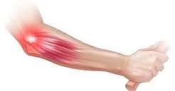 Tennis elbow lateral epicondyle tendinopathy illustration showing the extensor carpi radialis brevis tendon origin at the lateral epicondyle of the humerus with degeneration and microtears highlighted at the attachment site