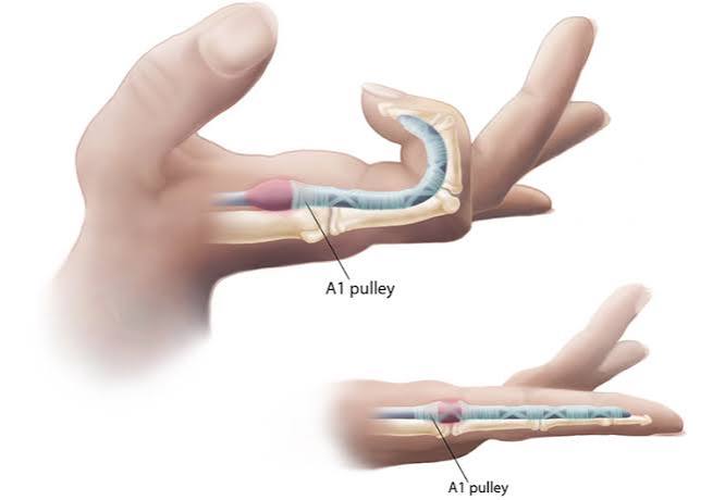 Trigger finger stenosing tenosynovitis diagram showing the flexor tendon nodule catching at the narrowed A1 pulley at the base of the finger causing the locking and clicking symptoms of trigger finger