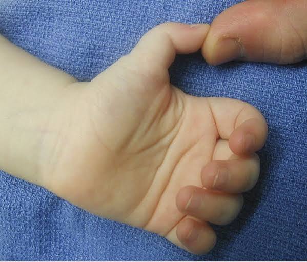 Trigger finger stenosing tenosynovitis illustration showing the flexor tendon nodule catching at the narrowed A1 pulley at the base of the finger causing the characteristic clicking and locking of trigger finger