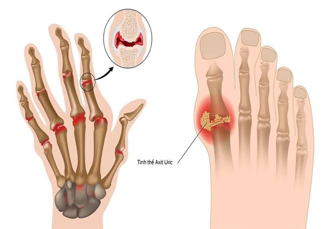 Uric acid and joint health — illustration showing the purine catabolism pathway producing uric acid via xanthine oxidase, MSU crystal formation in joints at elevated serum urate levels, and tophaceous deposits